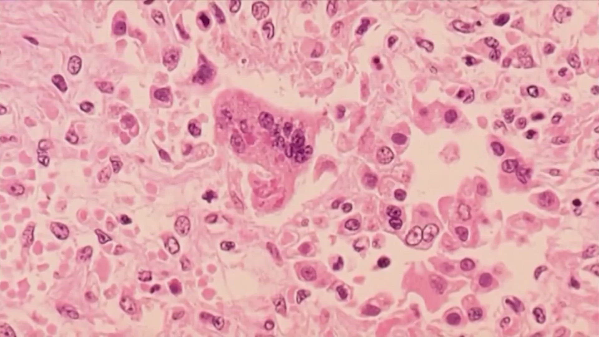 Measles is extremely infectious, and health officials have identified several potential exposure locations across the county.